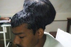 З голови чоловіка видалили найбільшу у світі пухлину