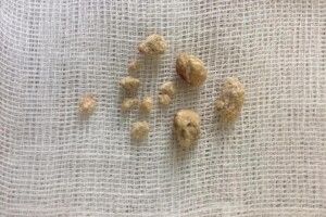 Волинські хірурги видалили жінці великий камінь нирки через сантиметровий розріз