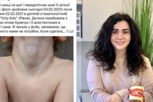 У Рівному 5-річна дівчинка вийшла від стоматолога з синцями та краплинами крові на шиї (Фото)