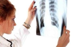 На Волині – ріст захворюваності на туберкульоз серед дітей