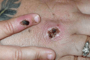 У світі підтвердили під сотню випадків мавпячої віспи