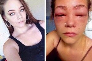 Фатальна помилка ледь не позбавила зору