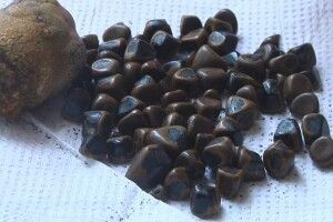 Волинські хірурги видалили пацієнтці понад 80 каменів з жовчного міхура