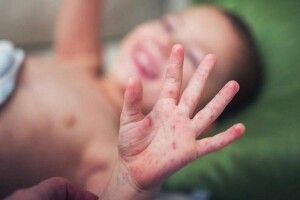 Нова напасть: у країнах ЄС дітей вражає загадкова хвороба
