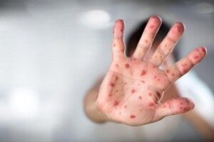 У Володимир-Волинському районі ще 8 дітей захворіли на кір