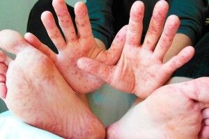 На Волині 6 лікарів захворіли на кір