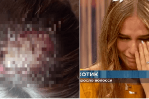 Шкіру роз’їло до черепа: рівнянка, якій перукарка зіпсувала вроду, розповіла про деталі скандалу (Відео)