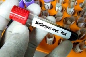 В Україні зареєстрували другий випадок віспи мавп