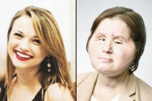 21-річній дівчині успішно трансплантували обличчя 