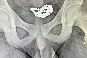 Інтимні експерименти: на Волині підлітки запхали в уретру магнітні кульки і потрапили в лікарню