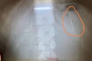 Тринадцятирічний хлопчик проковтнув голку