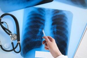 Супрун запропонувала скасувати тотальну флюорографію