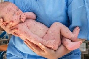 Від кору померло немовля