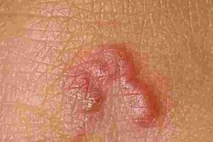 З обличчя жителя Рівненщини витягнули 8-сантиметрового гельмінта