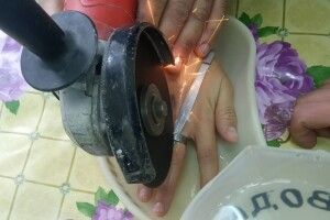 Бійцям ДСНС довелося болгаркою розпилювати саморобну каблучку на розпухлому пальці 14-річного хлопця