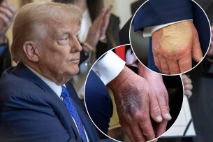 Дональду Трампу – 80: які хвороби приписували президенту США