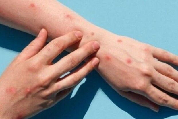 В Україні зареєстрували чотири випадки мавпячої віспи — МОЗ