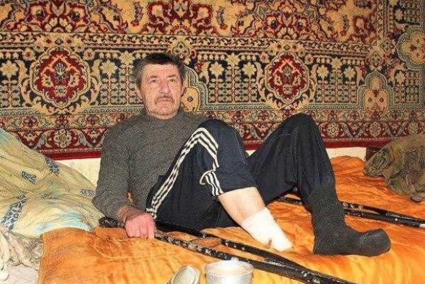 Шок: на Сумщині чоловік сам собі відрізав ступню через гангрену