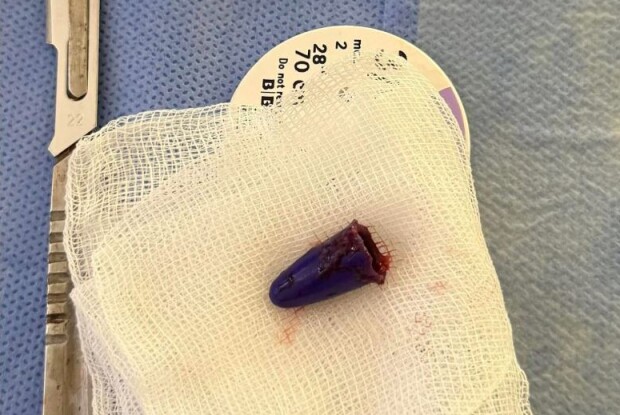 Учень на уроці проковтнув ковпачок від ручки