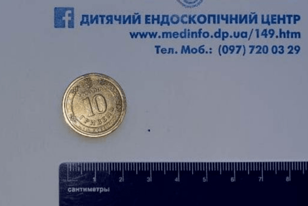 Ендоскопісти витягали зі стравоходу восьмирічної дитини 10-гривневу монету
