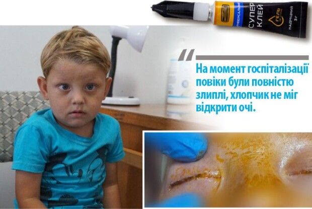 Трирічний хлопчик заклеїв собі очі суперклеєм