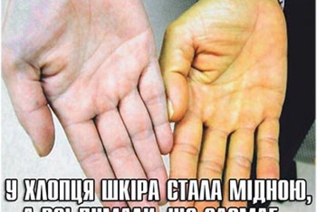 У ХЛОПЦЯ ШКІРА СТАЛА МІДНОЮ, А ВСІ ДУМАЛИ, ЩО ЗАСМАГ…