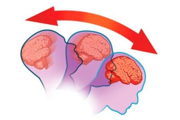 Струс мозку: як допомогти?