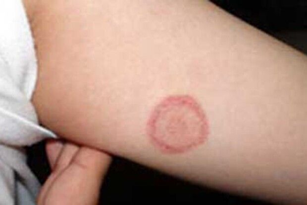 Як запобігти «котячому лишаєві». Секрети здоров'я