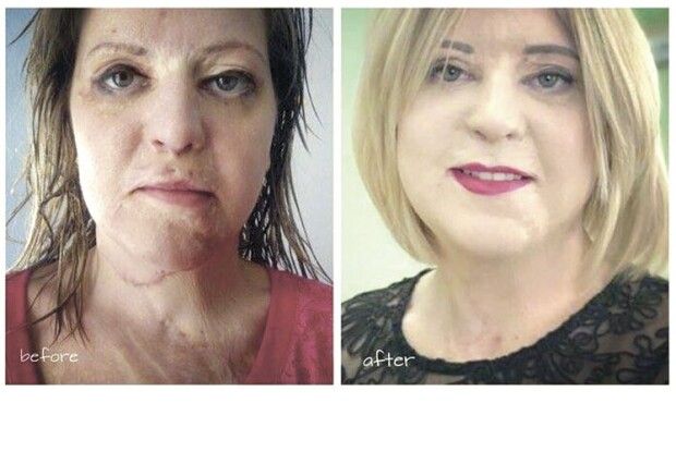 Жінка, яку 16 років тому спотворив сірчаною кислотою ображений залицяльник, чекає на двійню