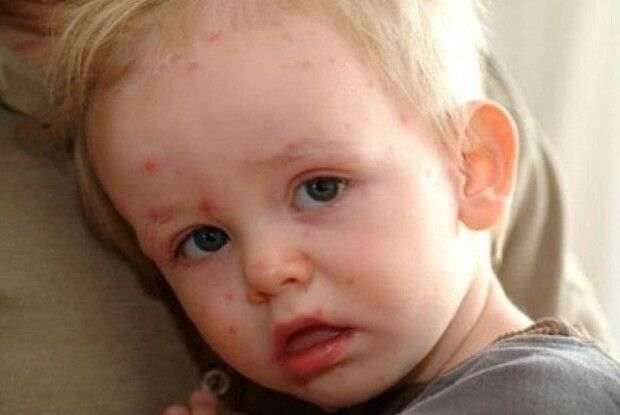 За одну добу в області зареєстровано 15 нових випадків кору