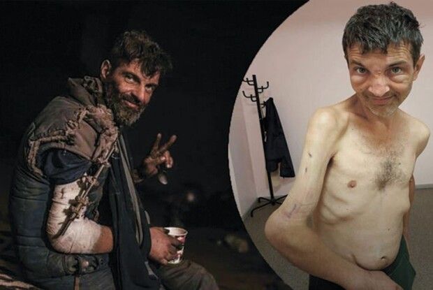 Звільнений із полону Михайло Діанов після операції на правиці мріє зіграти на улюбленій гітарі