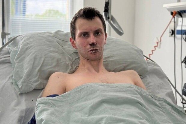 У Львові пересадили шкіру військовому з Волині, який під час бою отримав понад 50% опіків тіла