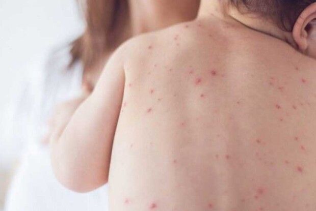 І не кажіть: «Подумаєш, вітрянка, розцяткую дитину зеленкою — ​і мине…»