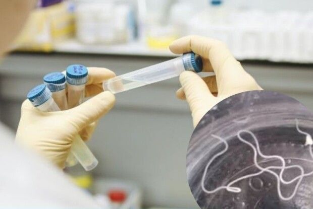 У рівнянина під шкірою був 9-сантиметровий гельмінт