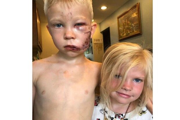 6-річний герой ціною власного здоров’я врятував сестричку від пса