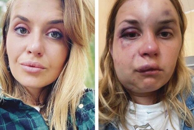 Журналістка, яку жорстоко побив і ледь не зґвалтував п’яний у поїзді, відсудила 100 тисяч 