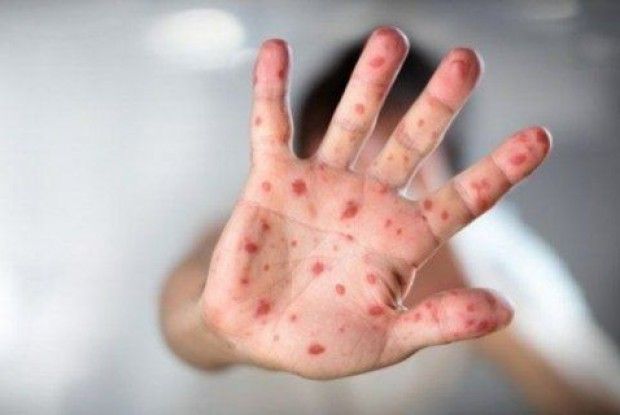 Від ускладнень кору померла дитина 