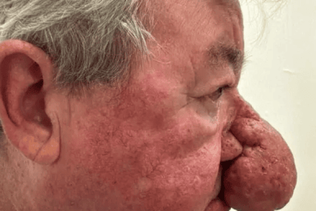 Навіть пива нормально не міг випити: лікарі врятували дідуся з найбільшим носом