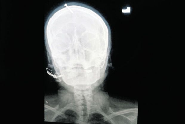 За порадою ворожбита вагітна… забила собі в голову цвях