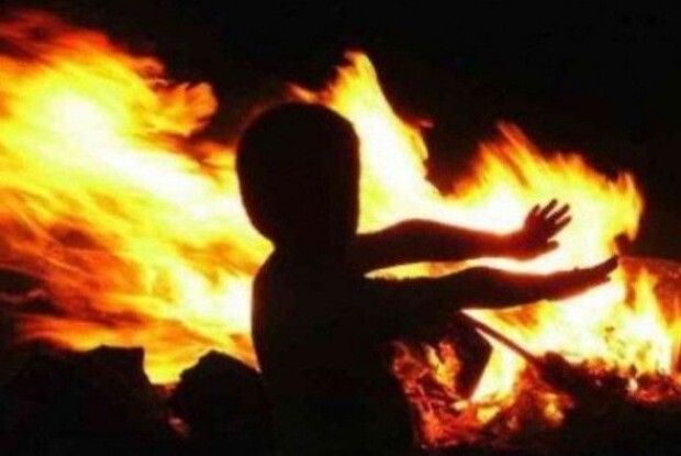 Дівчинка з Кореччини, яка впала у багаття, потребує допомоги