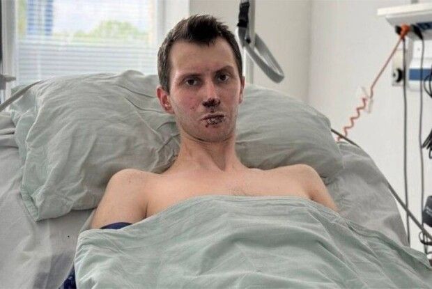 Палав, неначе факел: лікарі врятували бійця з Волині, який отримав 50% опіків тіла