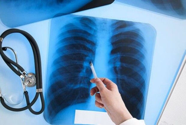 Супрун запропонувала скасувати тотальну флюорографію