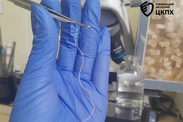 На Рівненщині з ока жінки видалили 11-сантиметрового паразита