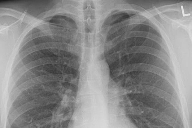 За тиждень на пневмонію захворіли 377 волинян