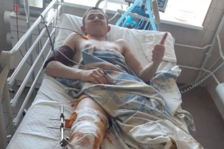 20-річному хлопцю лікарі пришили відрізану бензопилою ногу