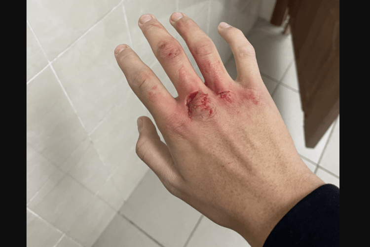 На Волині колишній  співмешканець порізав жінці руки ножем