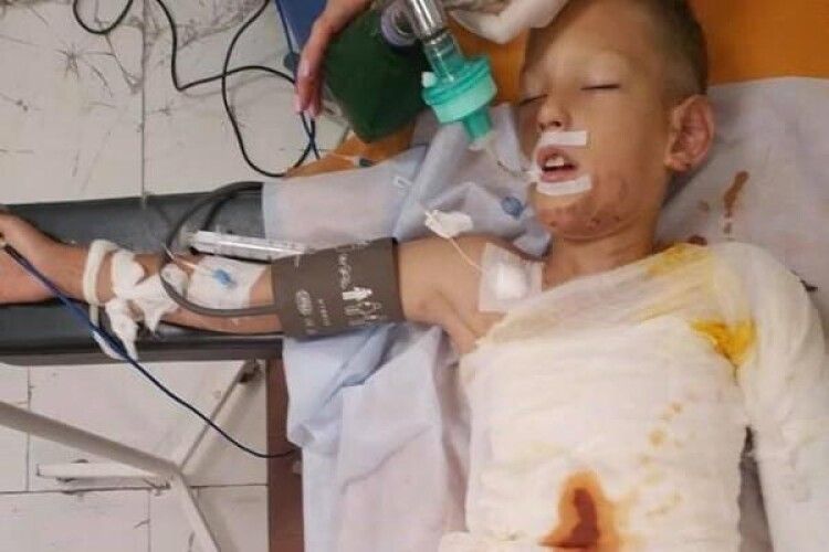 У Дніпрі облили бензином і підпалили восьмирічного хлопчика
