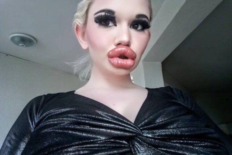 «Спочатку було боляче їсти»: дівчина зробила собі найбільші губи у світі (Фото)