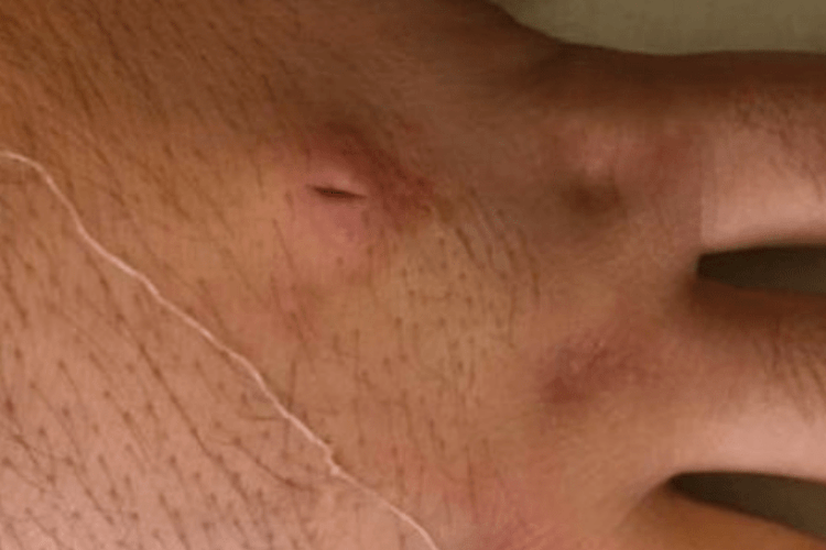 На Волині зафіксували два випадки дирофіляріозу