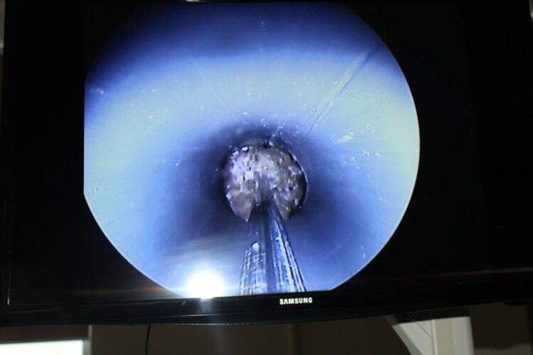 Волинські урологи вийняли пацієнту з нирки три камені через сантиметровий розріз (Фото 18+)